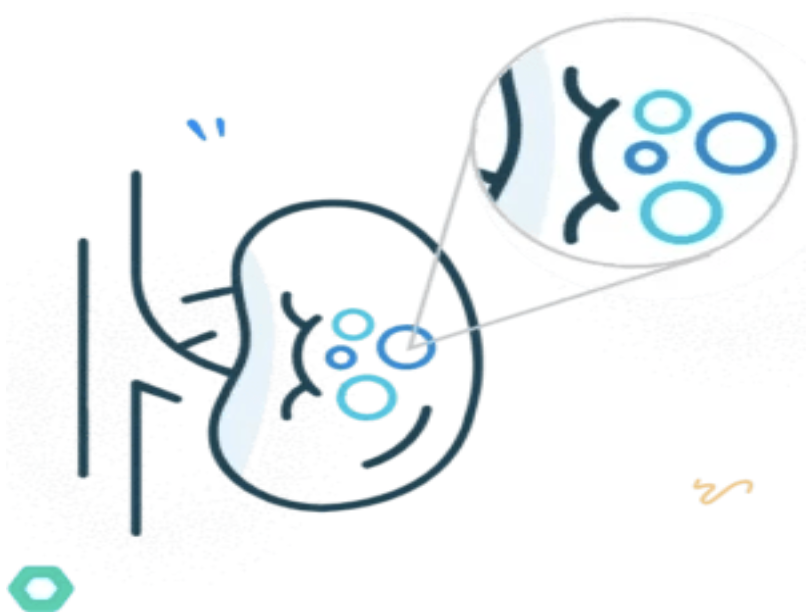 Cataract illustration