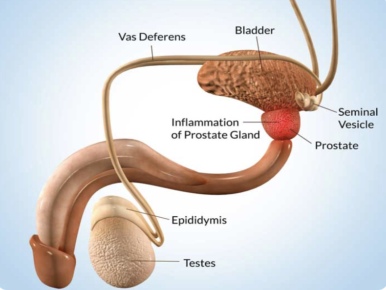 Cataract illustration